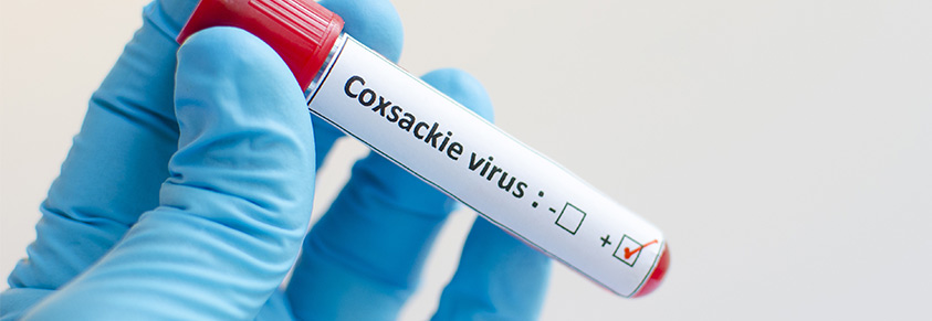 Coxsackie-Virus