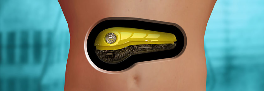 Eine künstliche Bauspeicheldrüse wird futuristisch illustriert