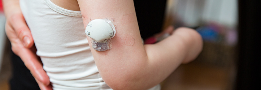 Kind mit CGM-Gerät am Arm