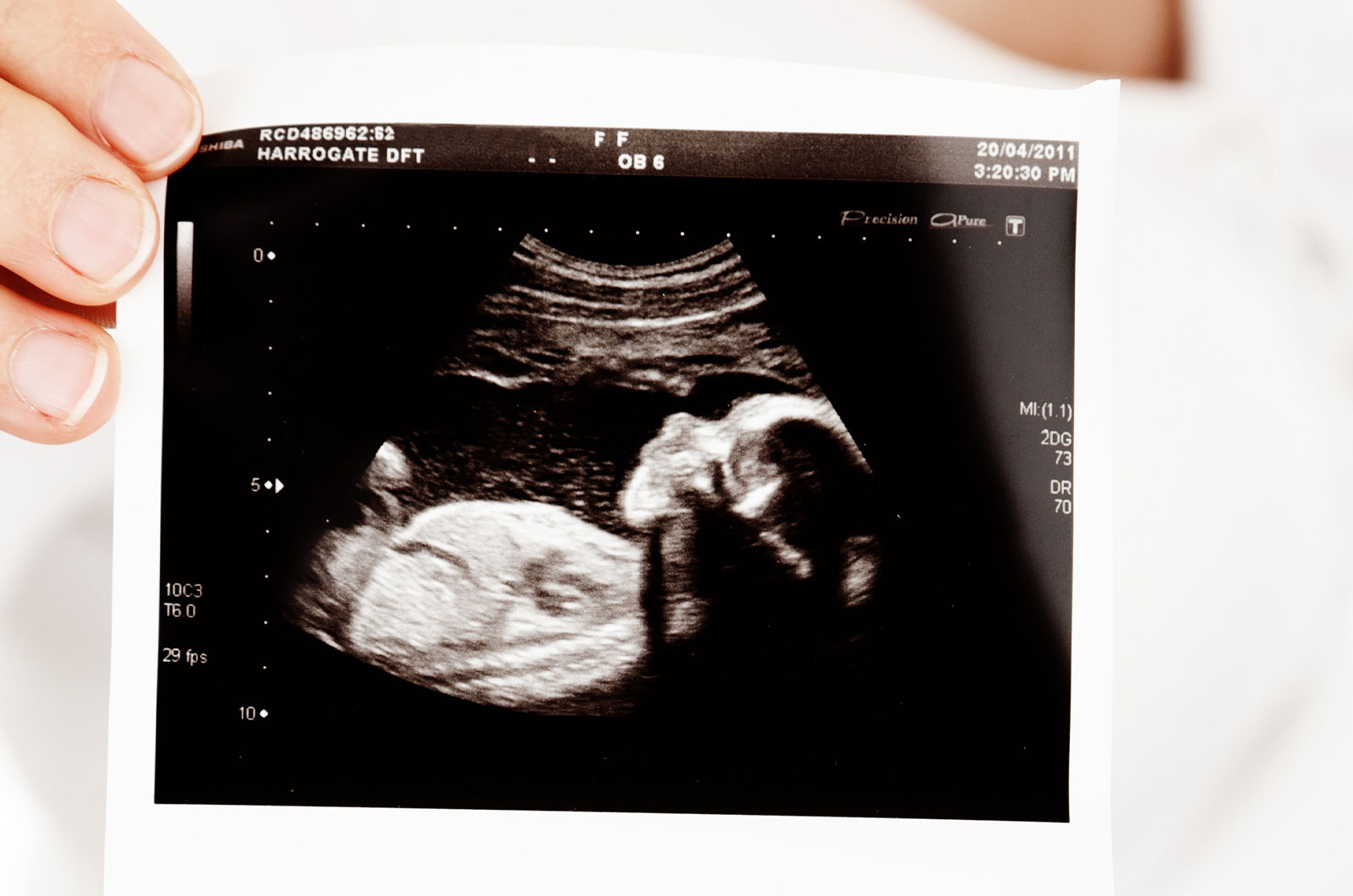 Ultraschallbild in einer Schwangerschaftswoche mit Abbildung eines Babys 