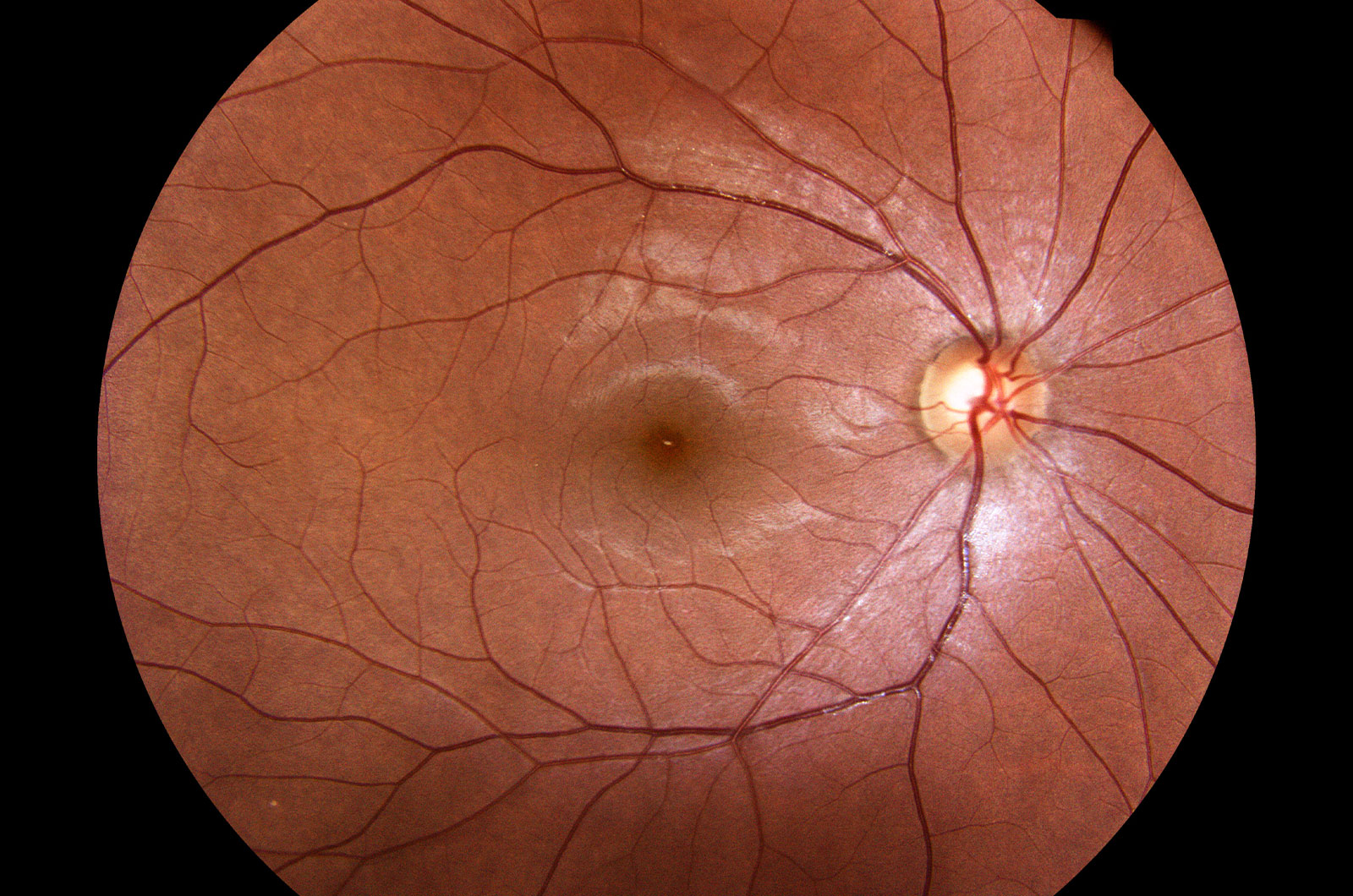 Medizinisches Foto einer abnormalen Retina des menschlichen Auges, Netzhautuntersuchung bei Diabetes
