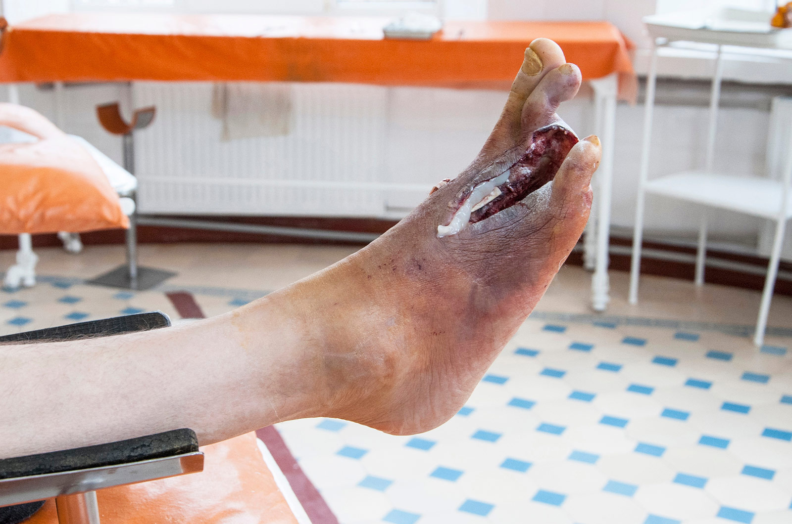 Diabetischer Fuß, Behandlung von Patienten mit diabetischen Fußgeschwüren, Amputation der Zehen