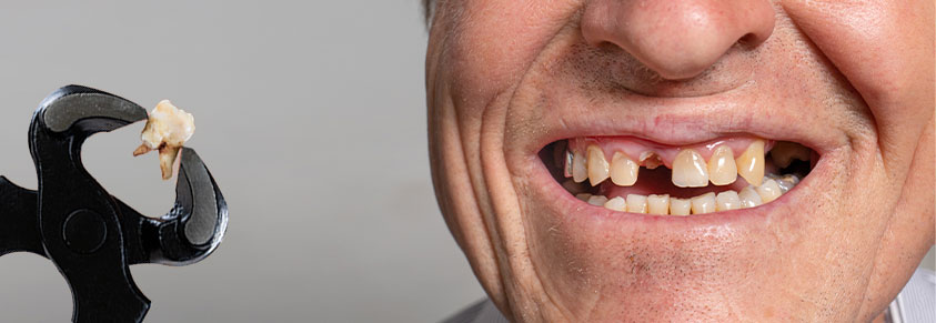 Mann mit fehlendem Zahn, Oberkiefer mit Zahnlücke, Kneifzange mit gezogenem Zahn
