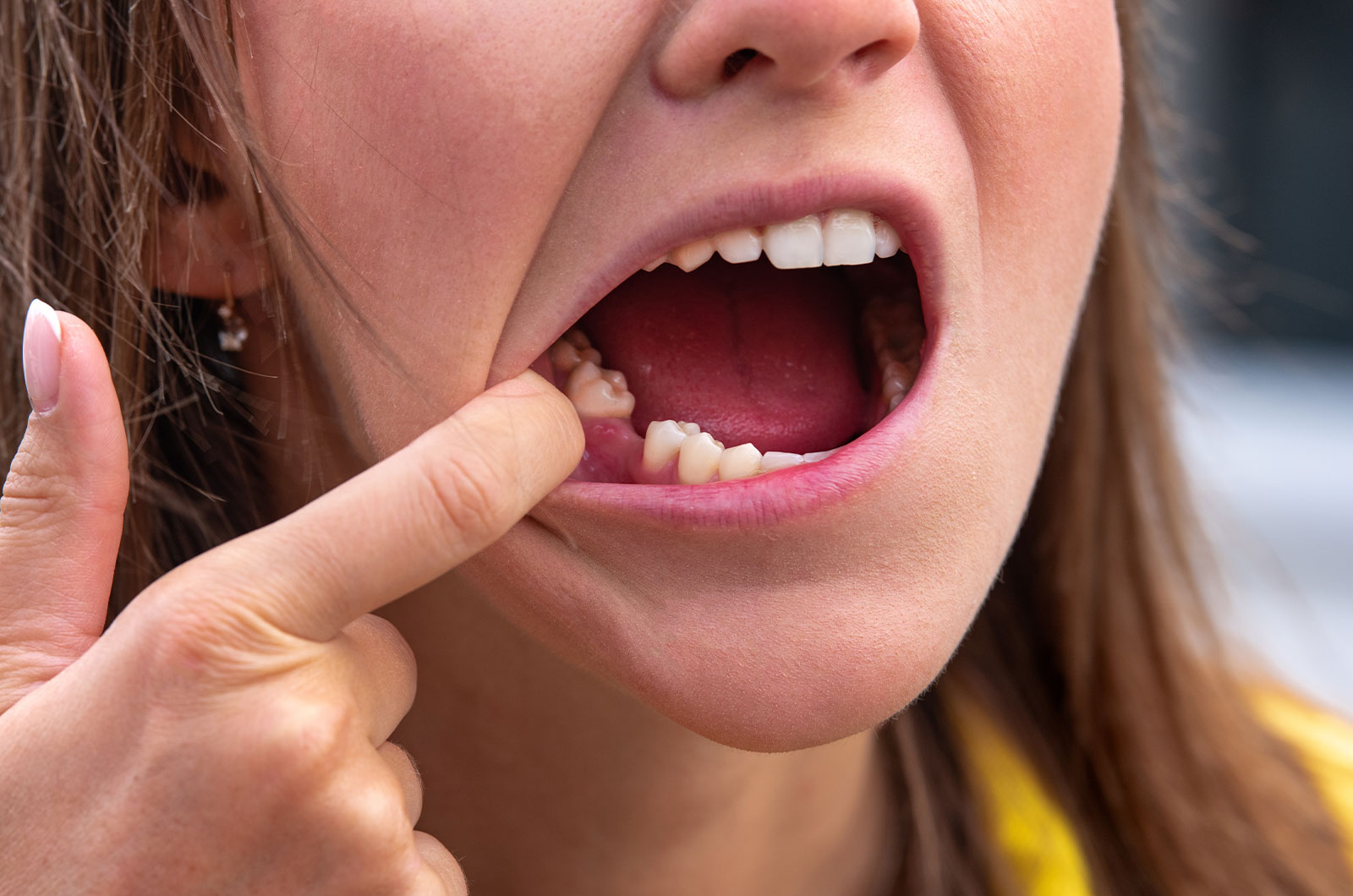 junge Frau mit fehlendem Zahn, Unterkiefer mit Zahnlücke