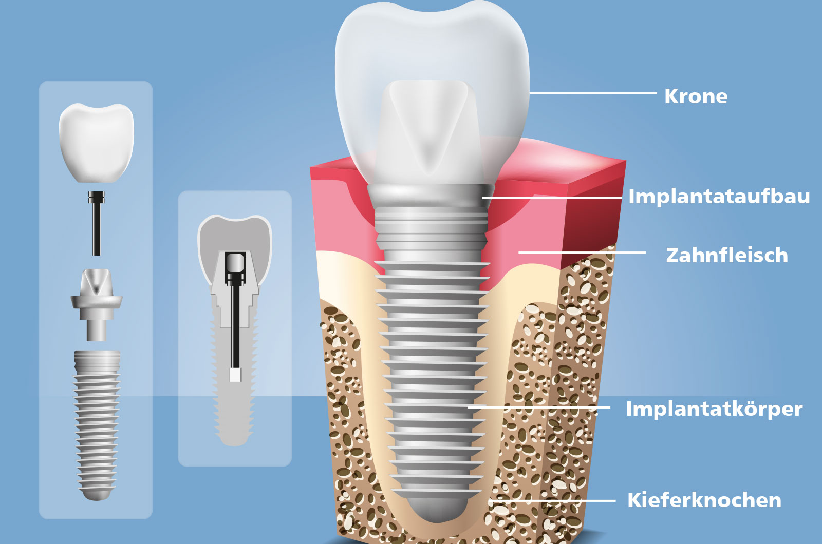 Aufbau Zahnimplantat, Krone, Implantataufbau, Zahnfleisch, Implantatkörper, Kieferknochen