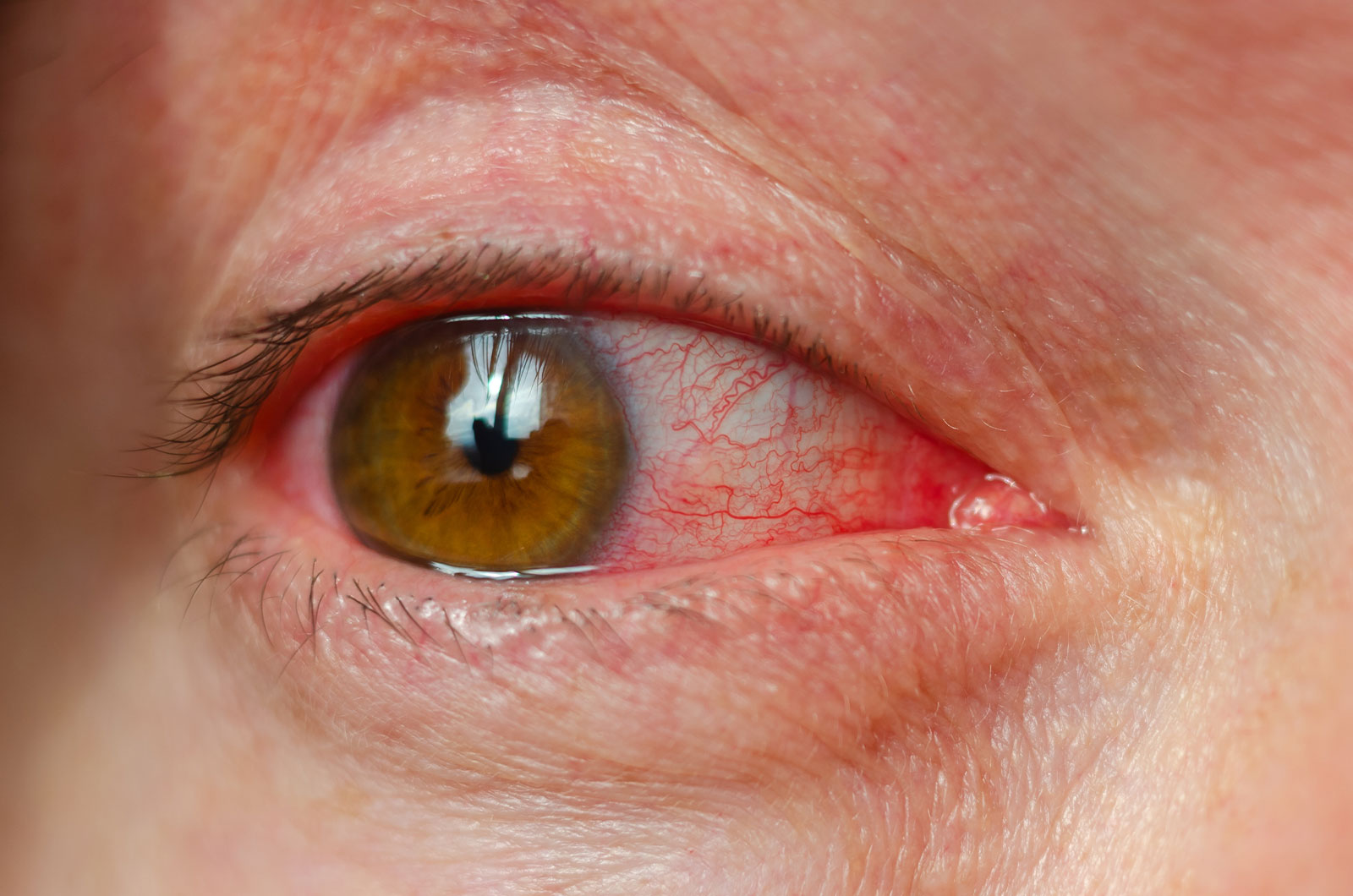 Nahaufnahme Auge mit Glaukomverdacht
