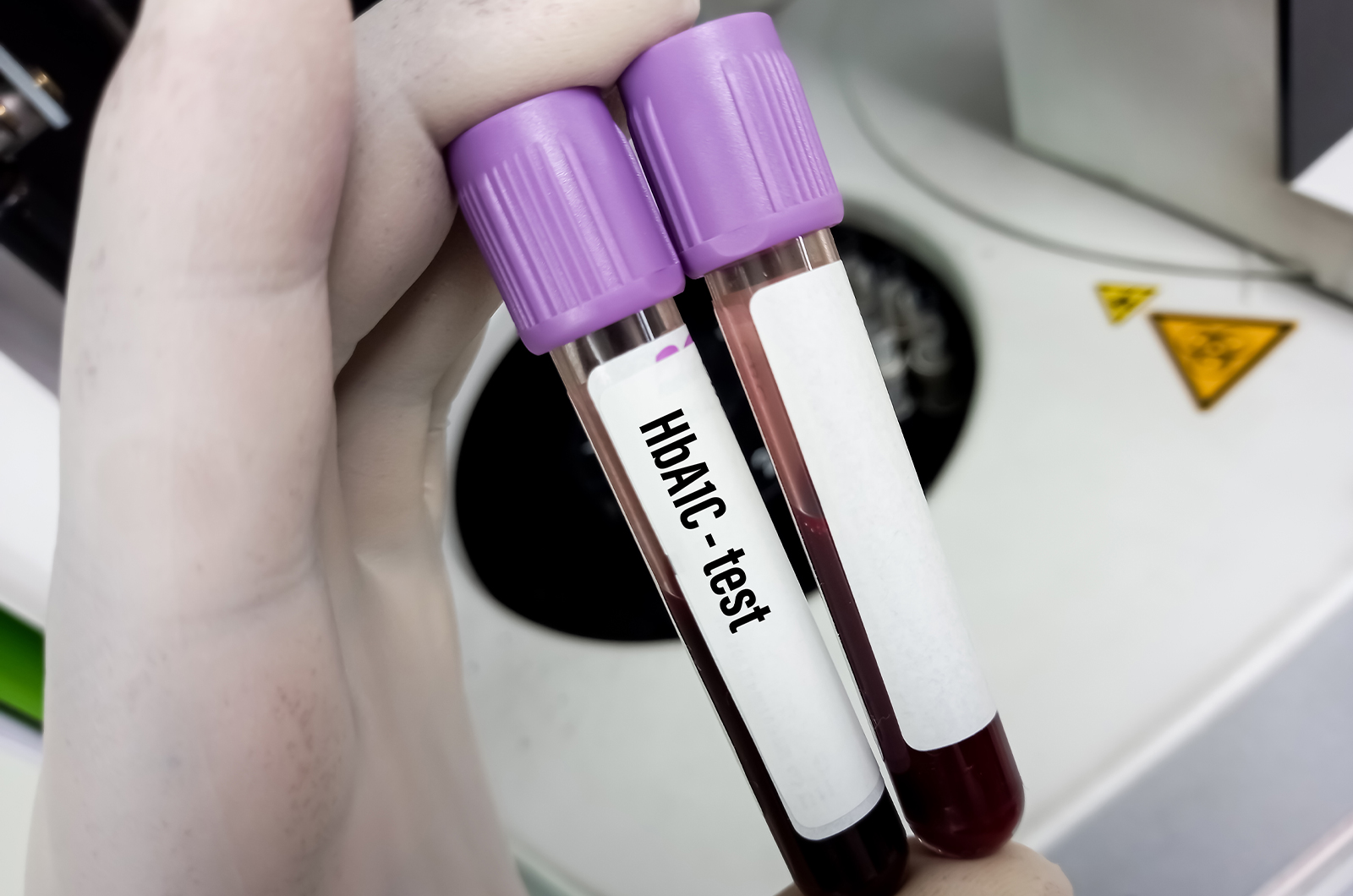 Blutprobe für den HbA1c-Test