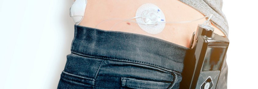 Eine Insulin-Pumpe und ein CGM-Sensor